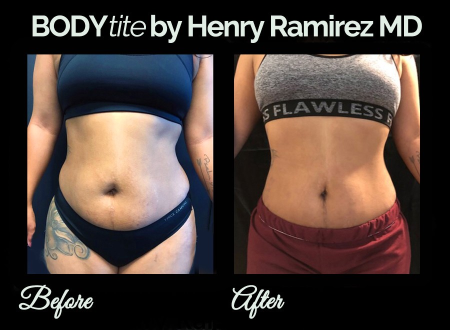 BodyTite procedure before and after photo (stomach) - BodyTite by Henry Ramirez MD in Ardmore, OK