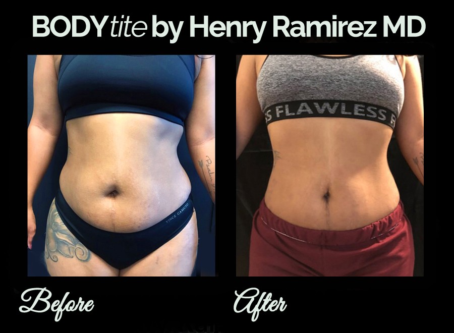 BodyTite: The Ultimate Guide to Radiofrequency Body Sculpting