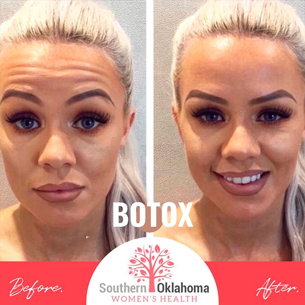 botox 004 - SOWH