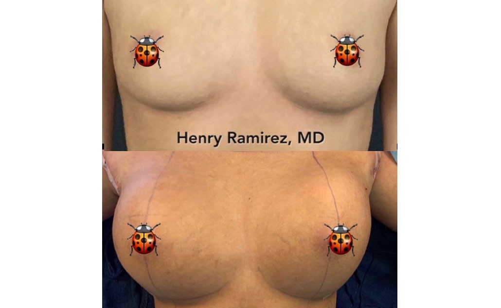 Breast augmentation - SOWH