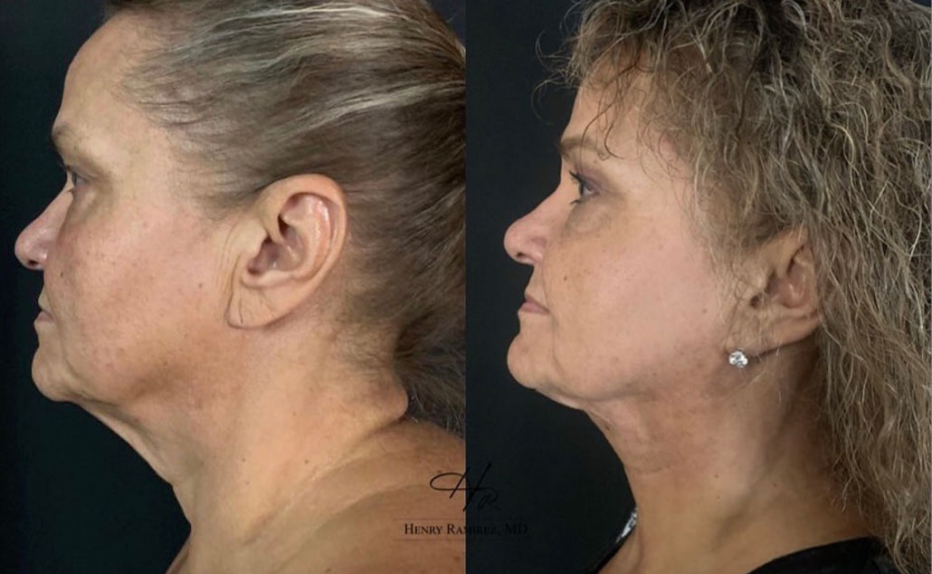 FaceTite with myellevate procedure - SOWH