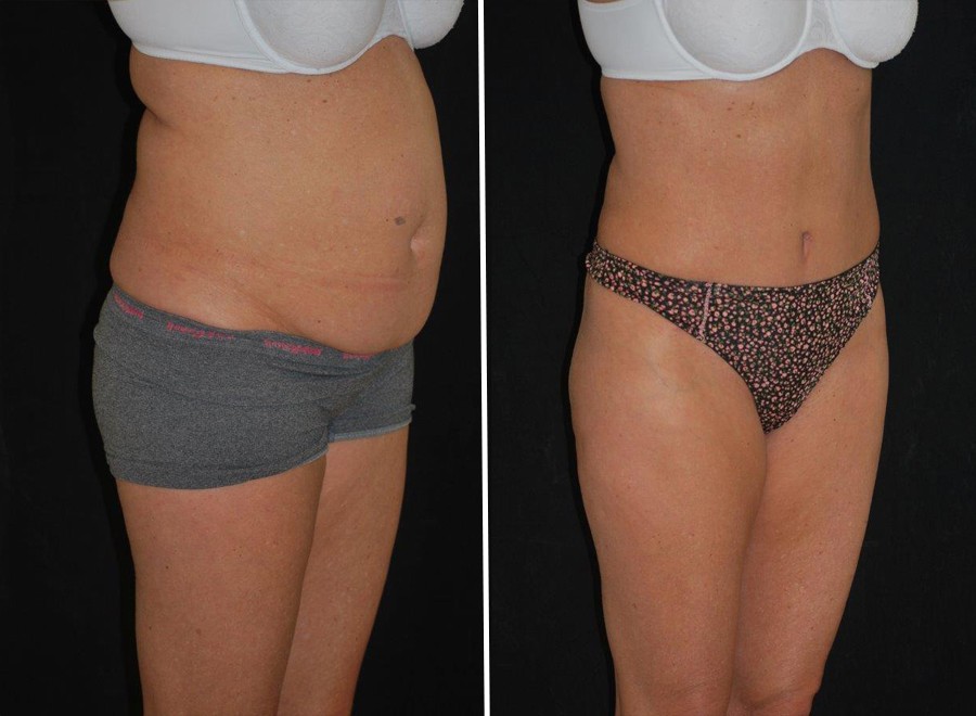 tummy tuck