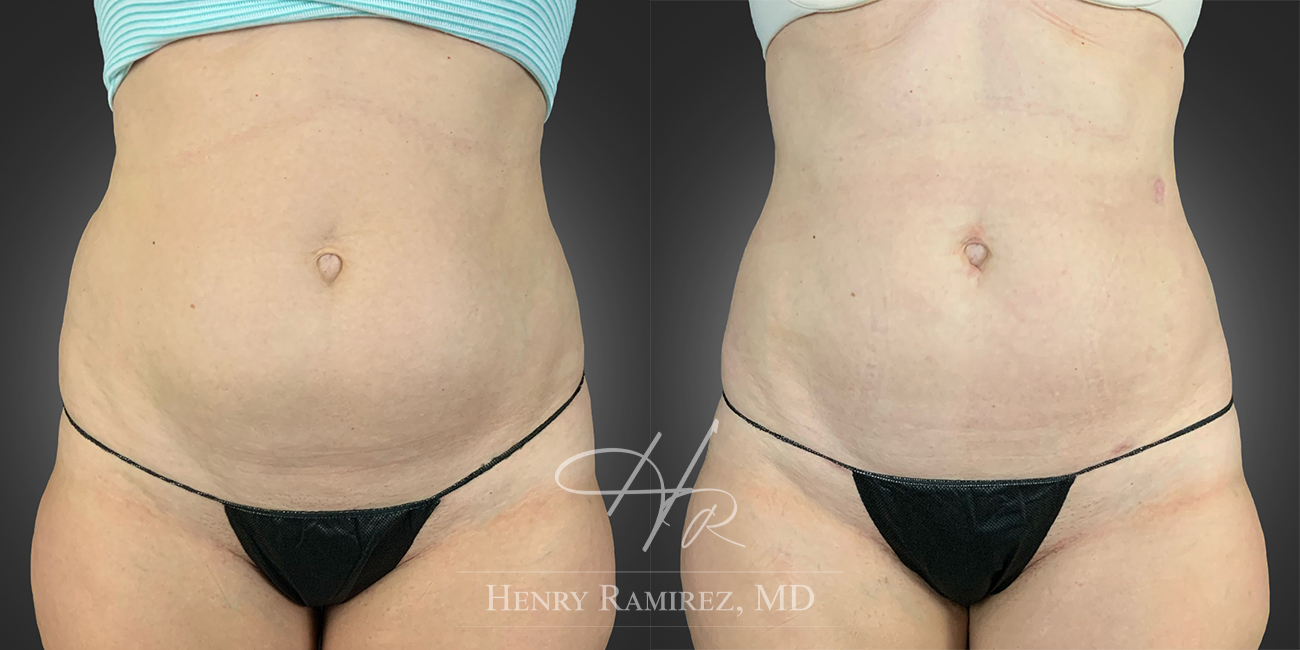 BodyTite procedure before and after photo (tummy) - BodyTite by Henry Ramirez MD in Ardmore, OK