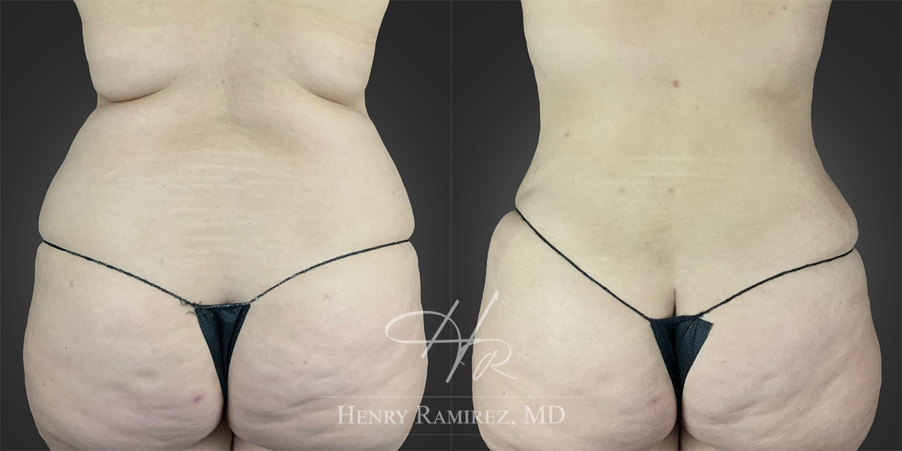 BodyTite procedure before and after photo (love handles) - BodyTite by Henry Ramirez MD in Ardmore, OK