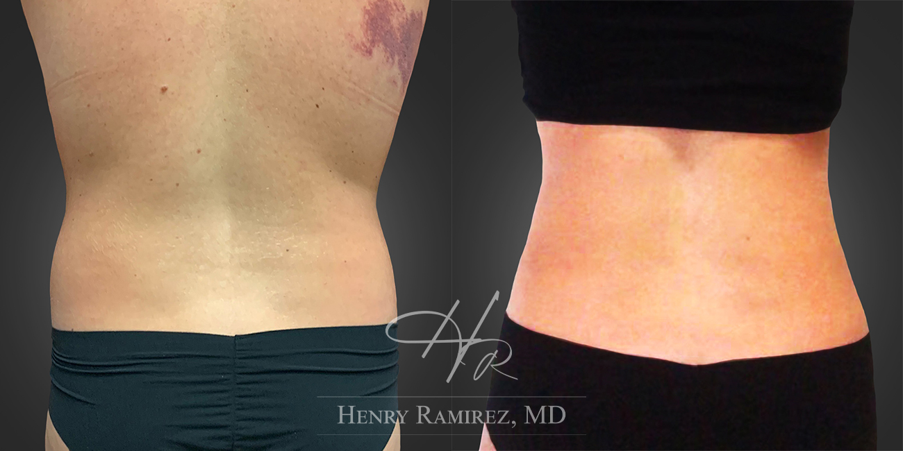 BodyTite procedure before and after photo (back) - BodyTite by Henry Ramirez MD in Ardmore, OK