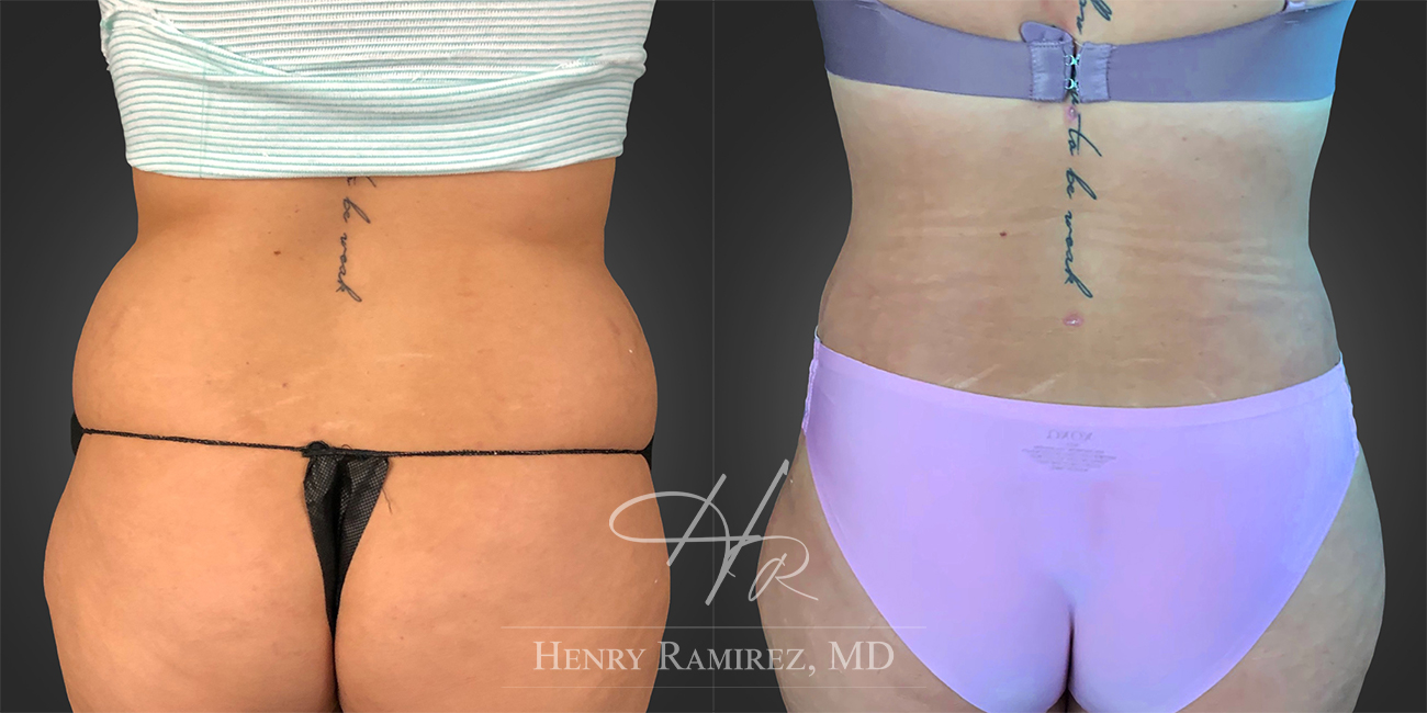 BodyTite procedure before and after photo (back and glutes) - BodyTite by Henry Ramirez MD in Ardmore, OK