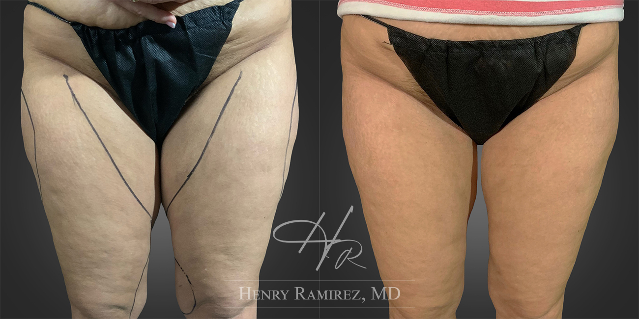 BodyTite procedure before and after photo (upper legs) - BodyTite by Henry Ramirez MD in Ardmore, OK