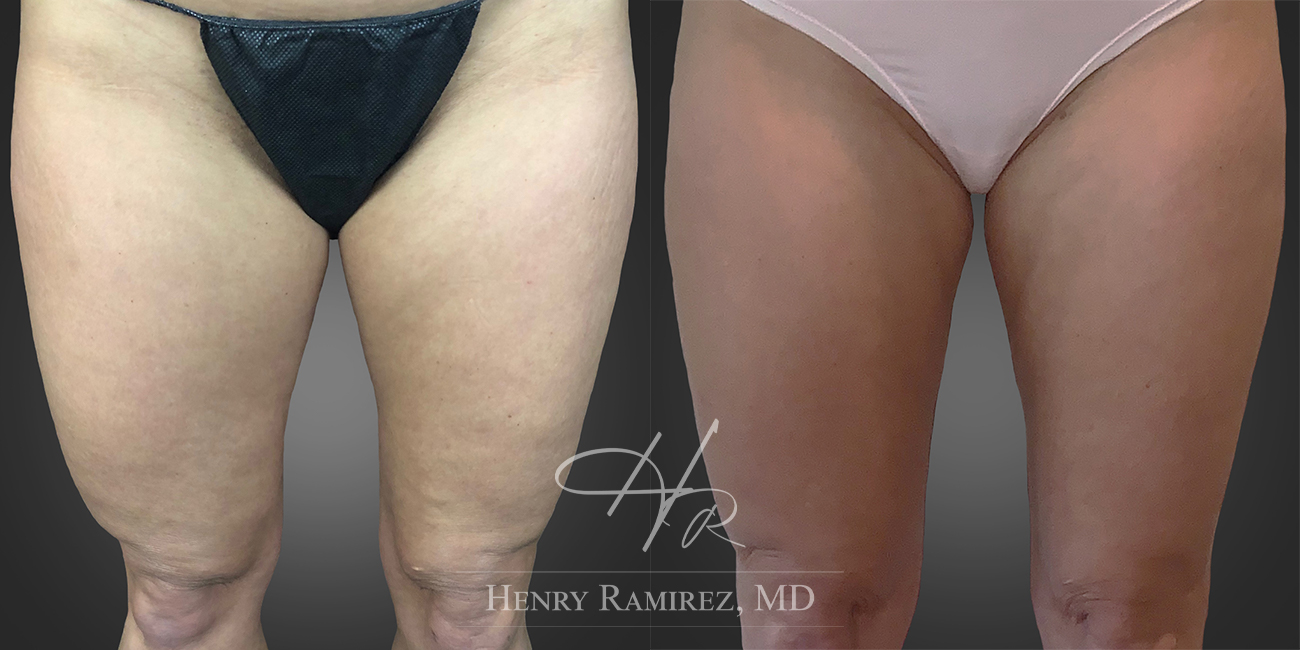 BodyTite procedure before and after photo (thighs) - BodyTite by Henry Ramirez MD in Ardmore, OK
