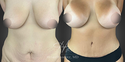BreastAugmentation3.1 Grid - SOWH