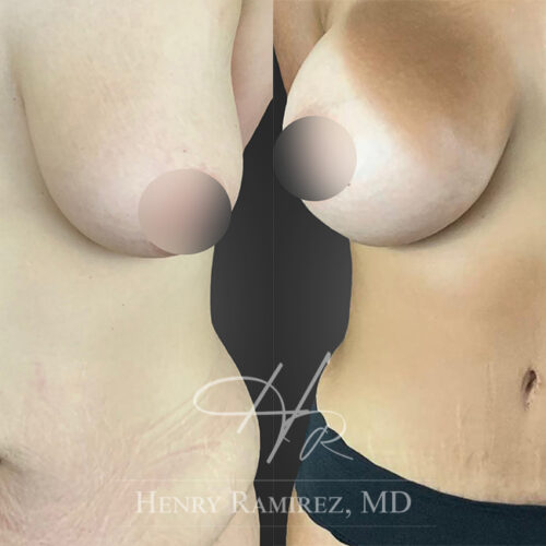 BreastAugmentation3.1-Zoom