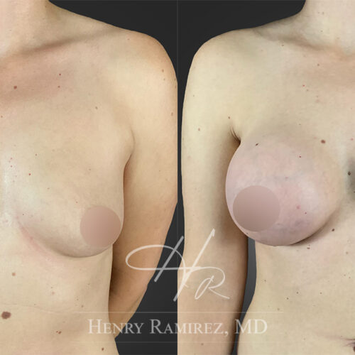 BreastAugmentation6.1-Zoom