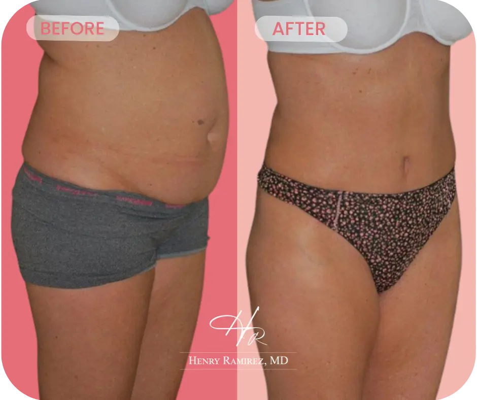 Tummy tuck before and after photo
