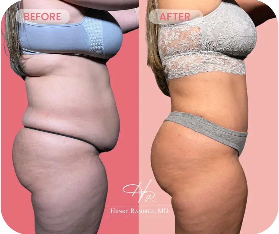 Tummy tuck surgery before and after photo