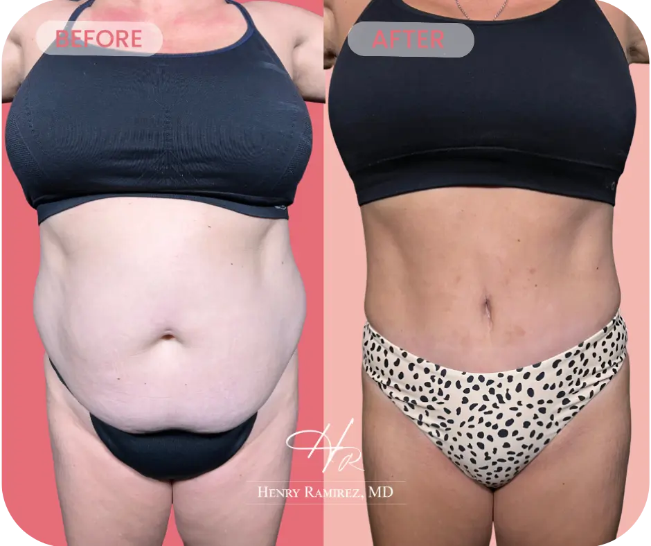 Tummy tuck surgery before and after