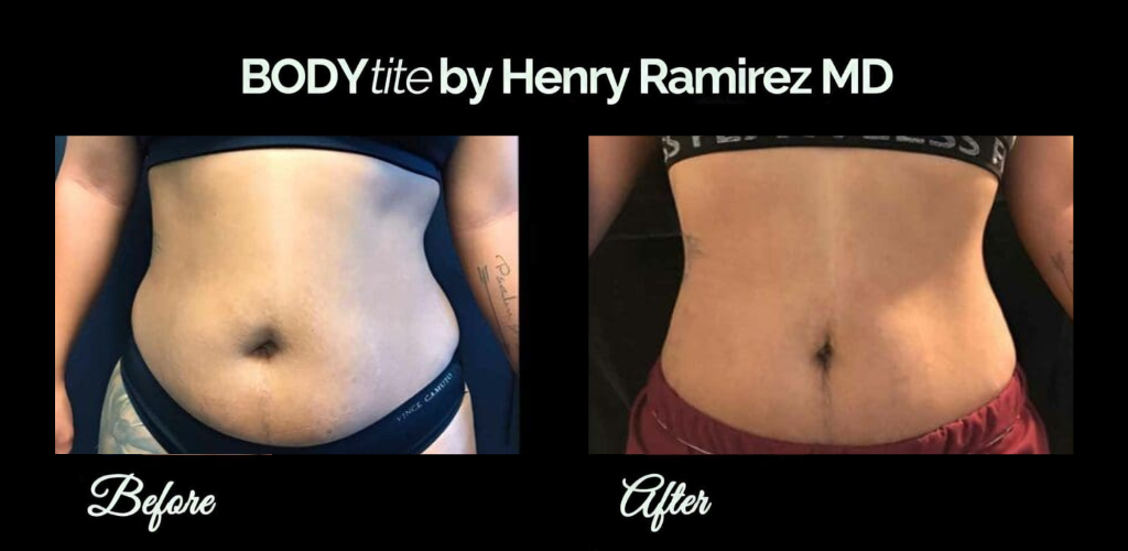 BodyTite for stomach - before and after photo