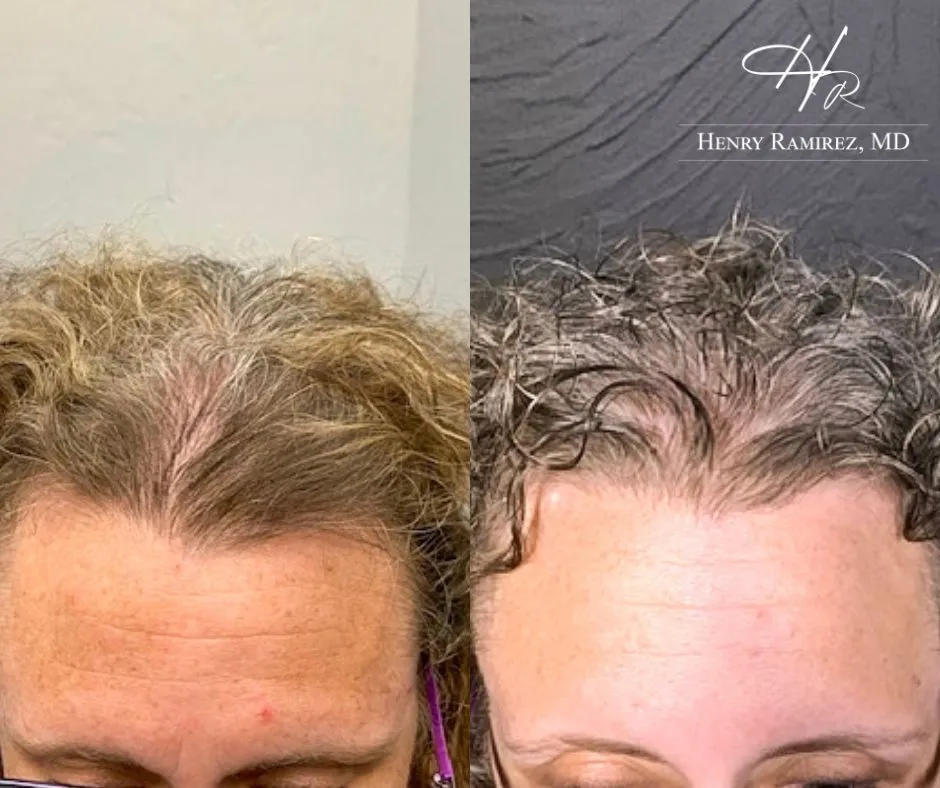 DeRive Advanced Hair Restoration Example by Henry Ramirez MD in Ardmore, OK