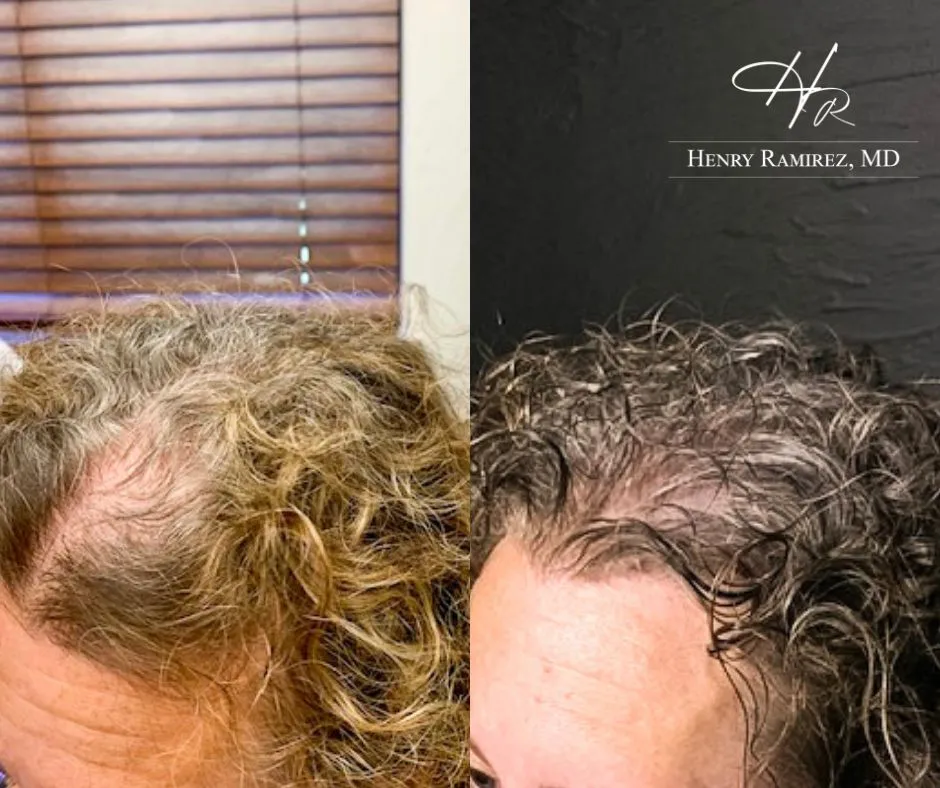 DeRive Hair Restoration for Women Example by Henry Ramirez MD in Ardmore, OK