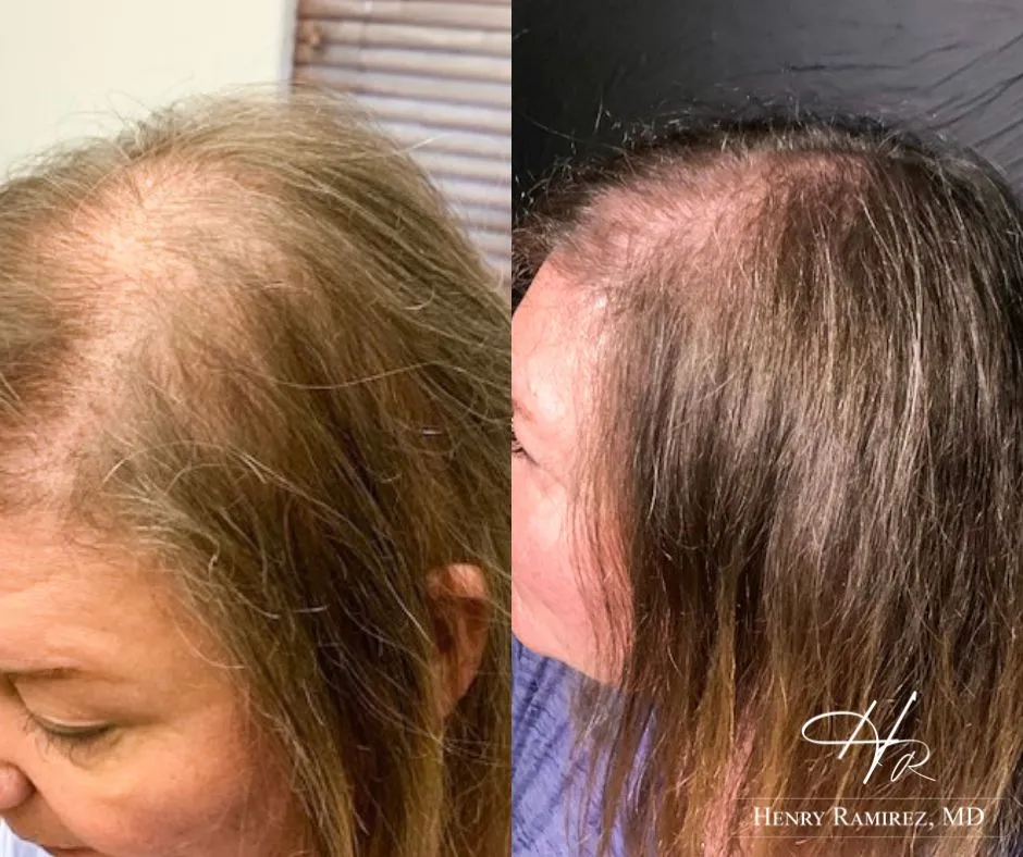 DeRive Hair Restoration Example by Henry Ramirez MD in Ardmore, OK
