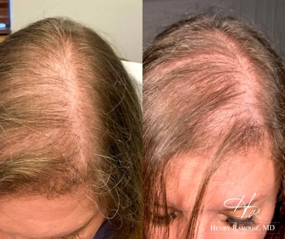DeRive Advanced Hair Restoration for Women Example by Henry Ramirez MD in Ardmore, OK